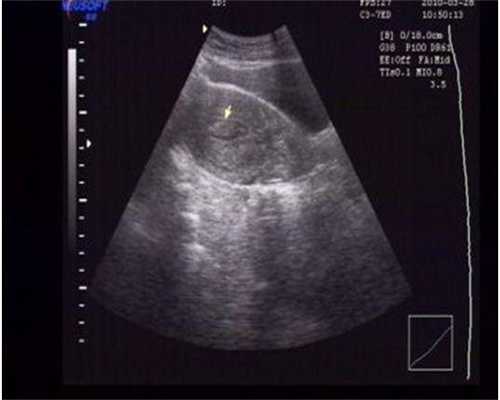 子宫内膜异位症重度做试管 子宫内膜异位症重度做试管有用吗