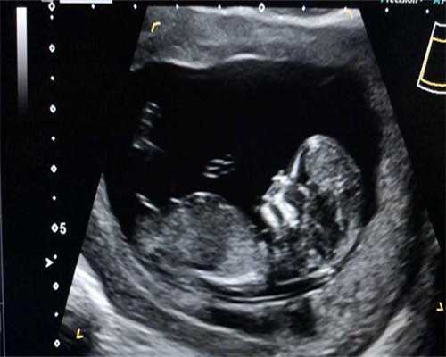 多囊卵巢做试管促排卵，多囊卵巢做试管促排卵有用吗