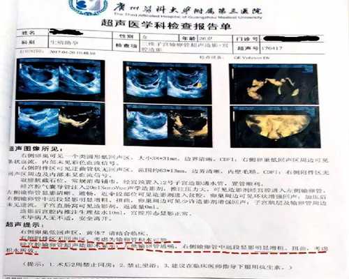 卵巢囊肿选几代试管好一点？卵巢囊肿做试管适合什么方案？